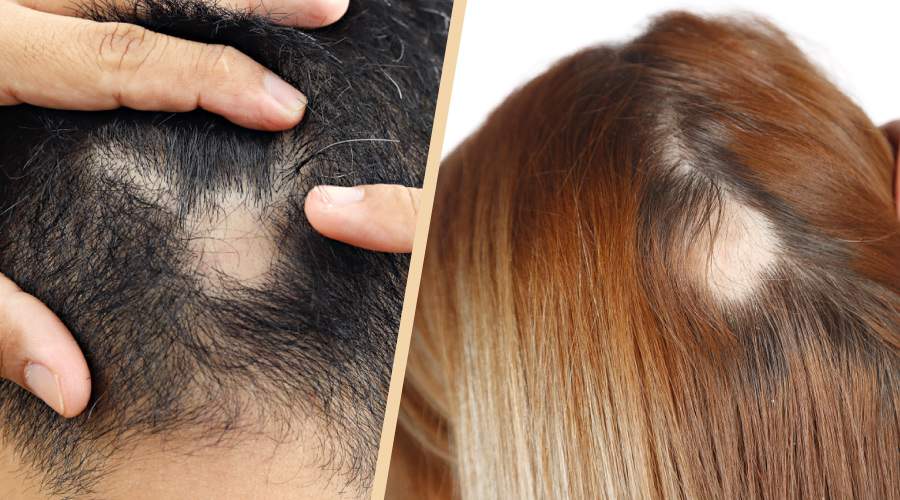 Hair Loss Causes and How Trans hair Vizag Can Restore Your Confidence